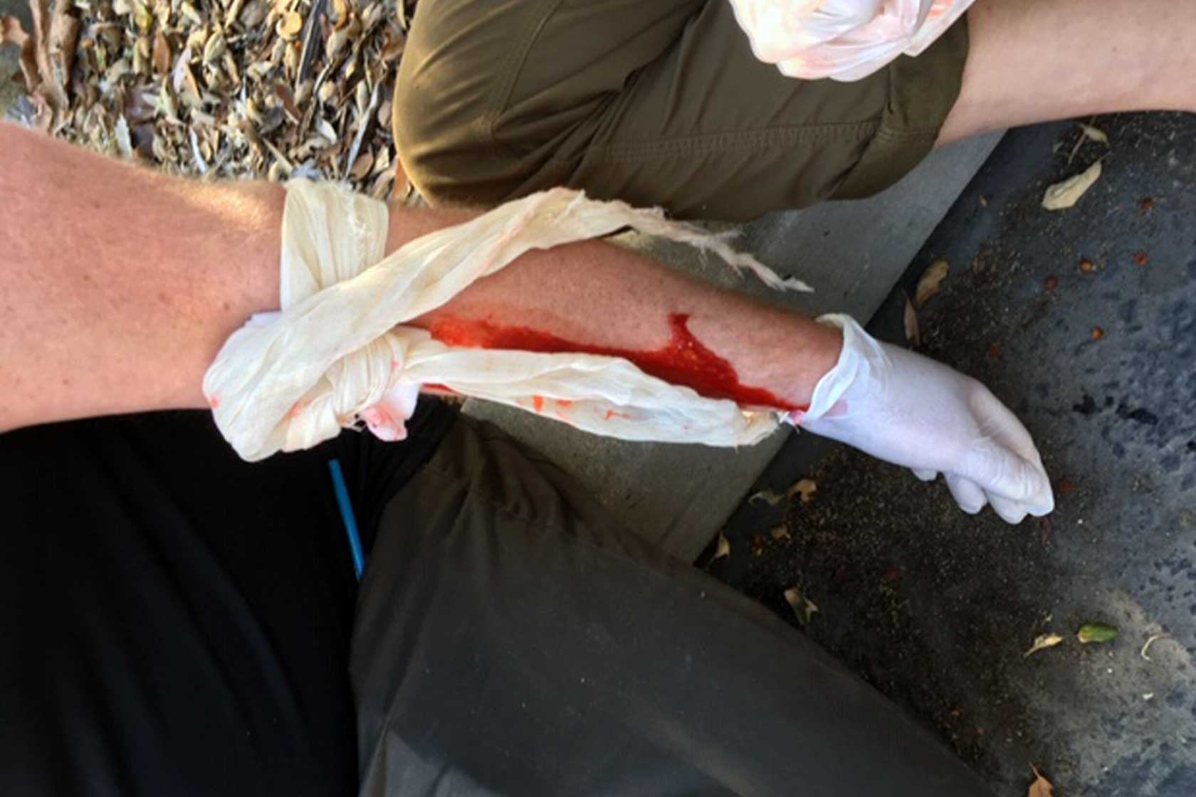 Bandaged bleeding arm